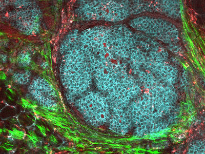 Microscopic view of a breast cancer tumor